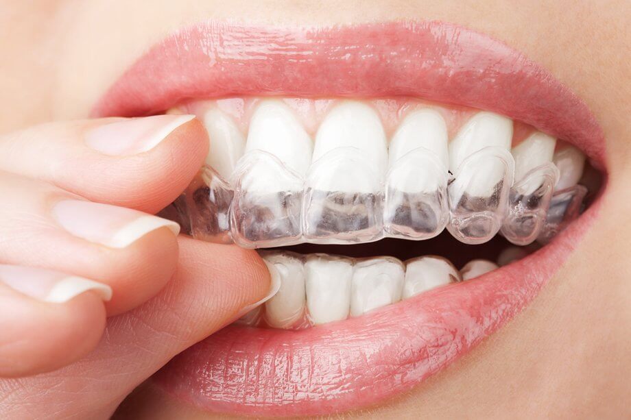 Can Invisalign Fix An Underbite