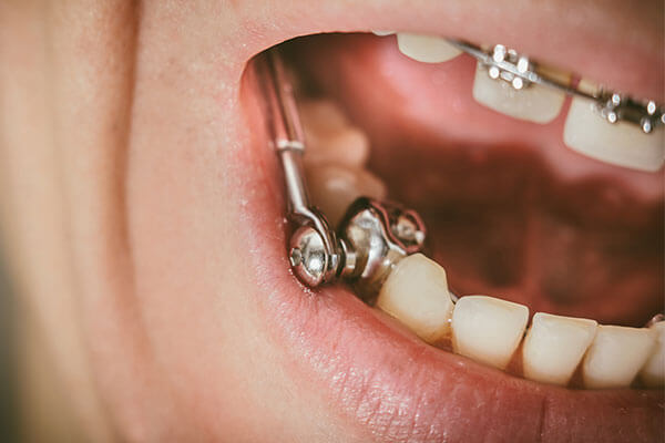 Metal Braces