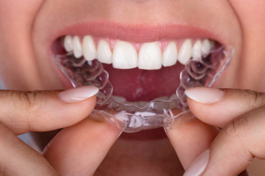 How Does Invisalign Work?