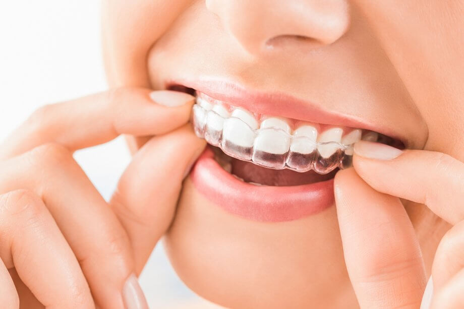 How Long Does Invisalign Take?