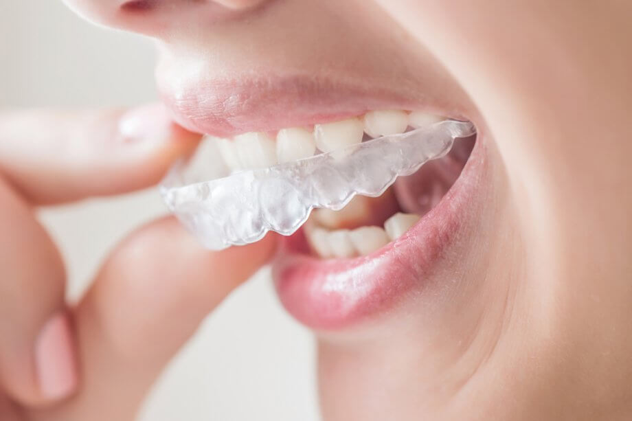 How Long Does Invisalign Take For A Teen?